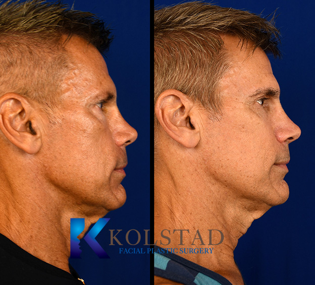 Before and after eyebrow transplant showing fuller, natural-looking eyebrow growth and improved definition from a side profile view.