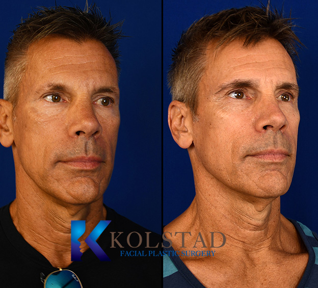 Before and after eyebrow transplant showing fuller, naturally shaped eyebrows with improved hair density and definition.