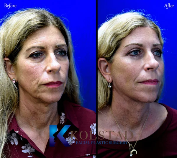 http://face-lift-la-jolla-35-600x534-copy