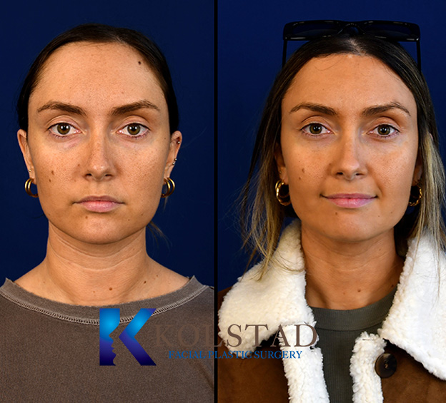 Before and after forehead reduction showing a lower, more balanced hairline and improved forehead proportions from a front-facing view.
