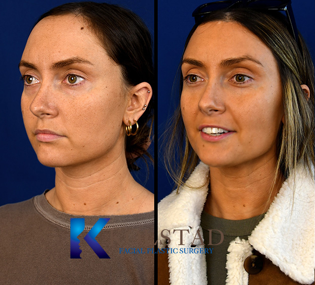 Before and after forehead reduction showing a lower hairline and more balanced forehead proportions with a natural-looking result.