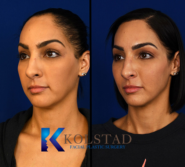 Before and after hair transplant showing improved hair density and a fuller-looking hairline from a diagonal view.