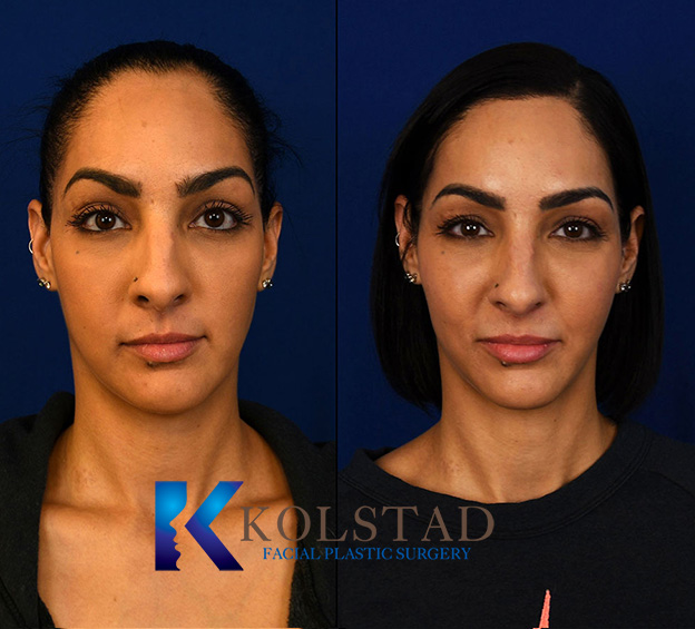 Before and after hair transplant showing increased hair density and a fuller, natural-looking hairline.
