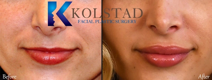 Lip filler before and after showing enhanced lip volume and definition with a balanced, natural-looking result in San Diego
