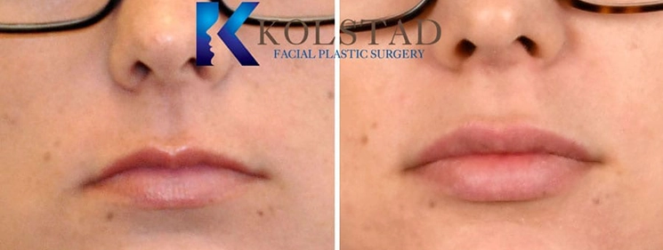 Lip filler before and after showing natural-looking lip volume, improved definition, and balanced proportions in San Diego, California