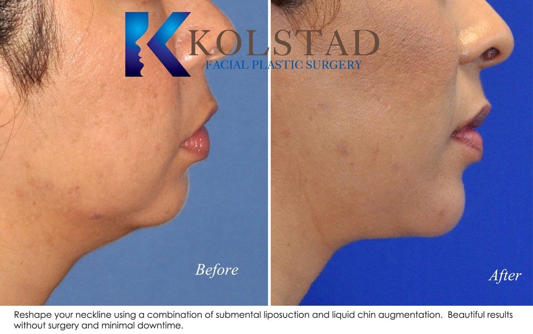http://liquid-chin-augmentation-san-diego-50-copy-1