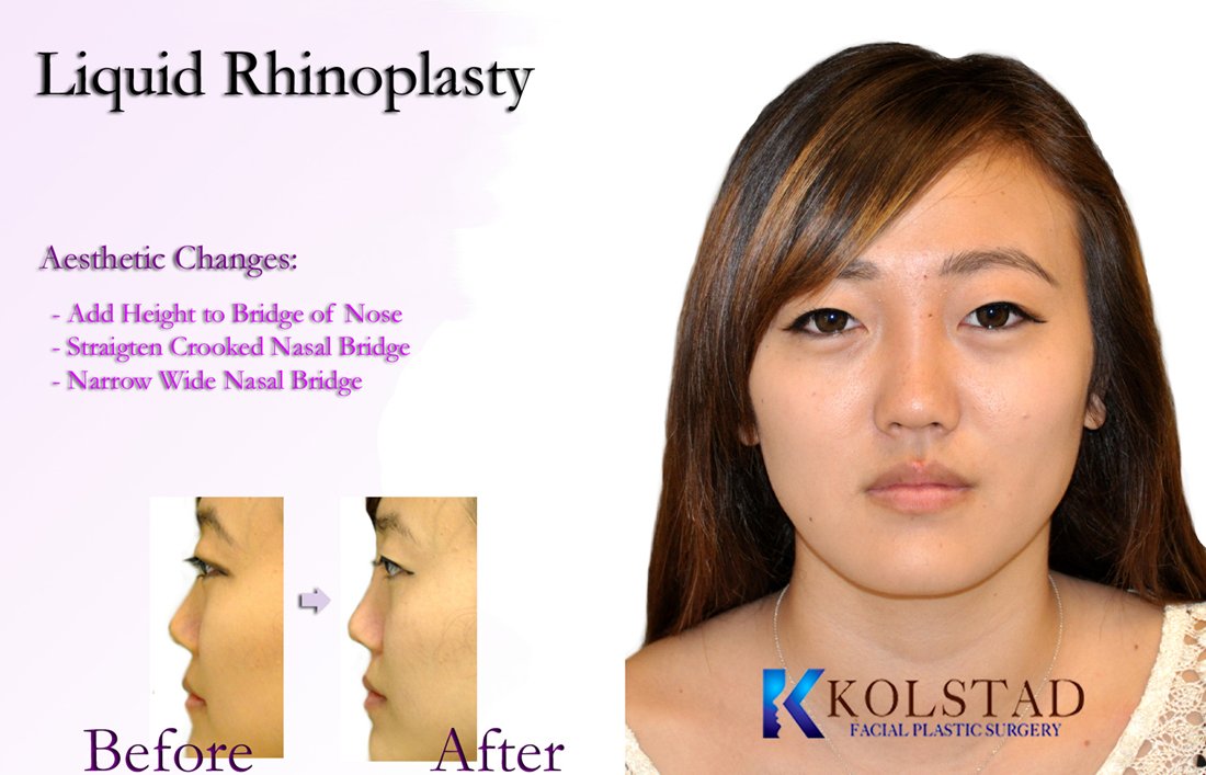 http://liquid-rhinoplasty-2