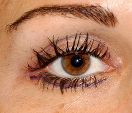 http://lower-eyelid-incision