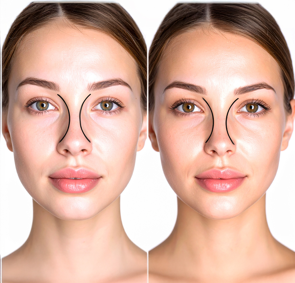 Before and after rhinoplasty showing temporary nasal swelling that can make the nose appear wider during the healing process.