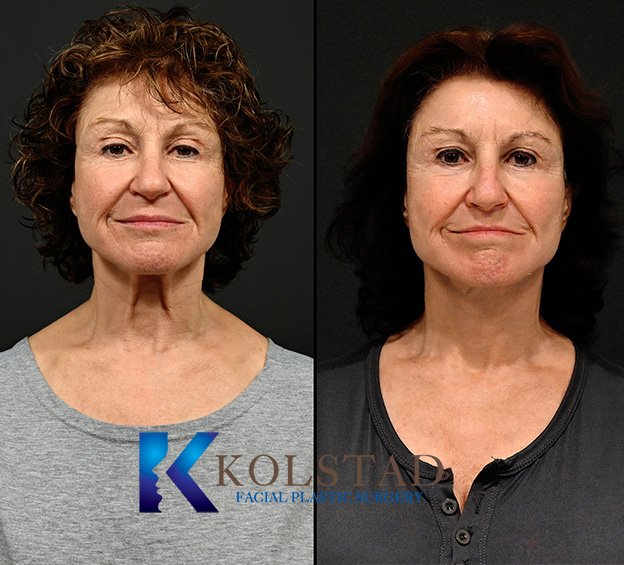 revision facelift 3