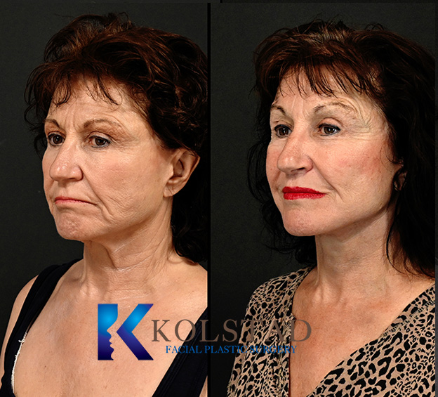 revision facelift 4