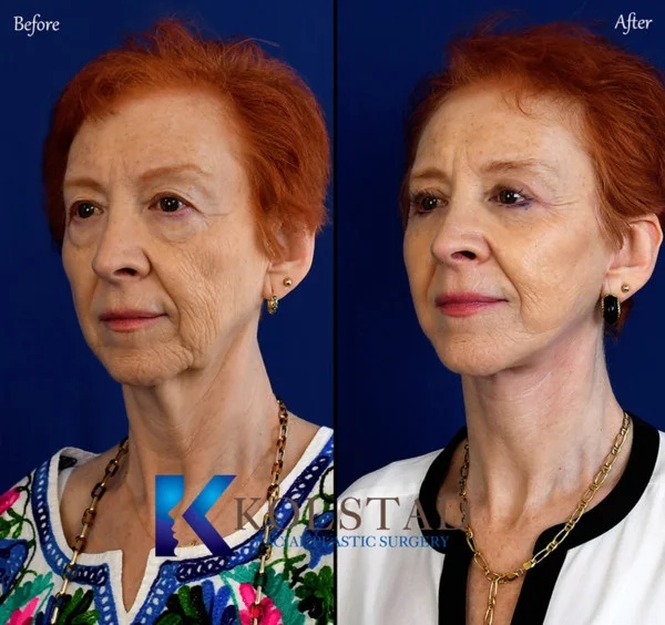 http://san-diego-best-facelift-600x564-copy