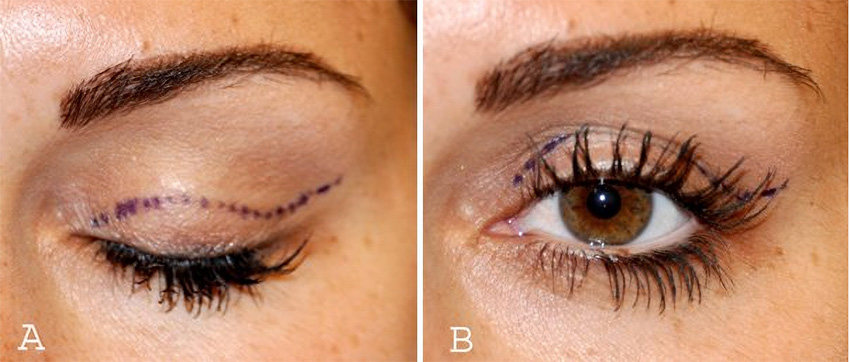 http://upper-eyelid-incision