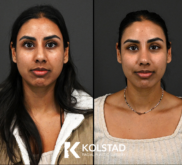Before and after preservation nose job with profile view showing a smoother nasal contour and natural-looking facial harmony.