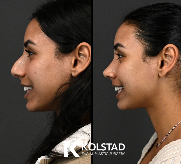 Before and after preservation rhinoplasty showing natural nasal refinement with improved facial balance for a patient in San Diego, California.