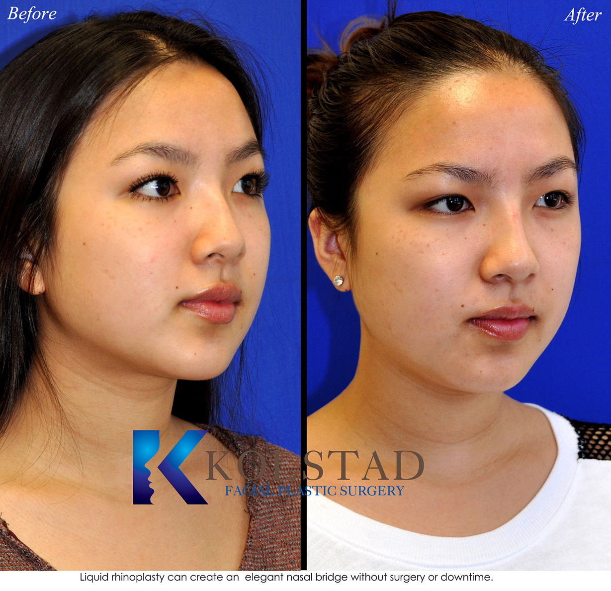 Before and after Asian rhinoplasty showing natural nasal refinement and improved facial harmony while preserving the patient's ethnic features.