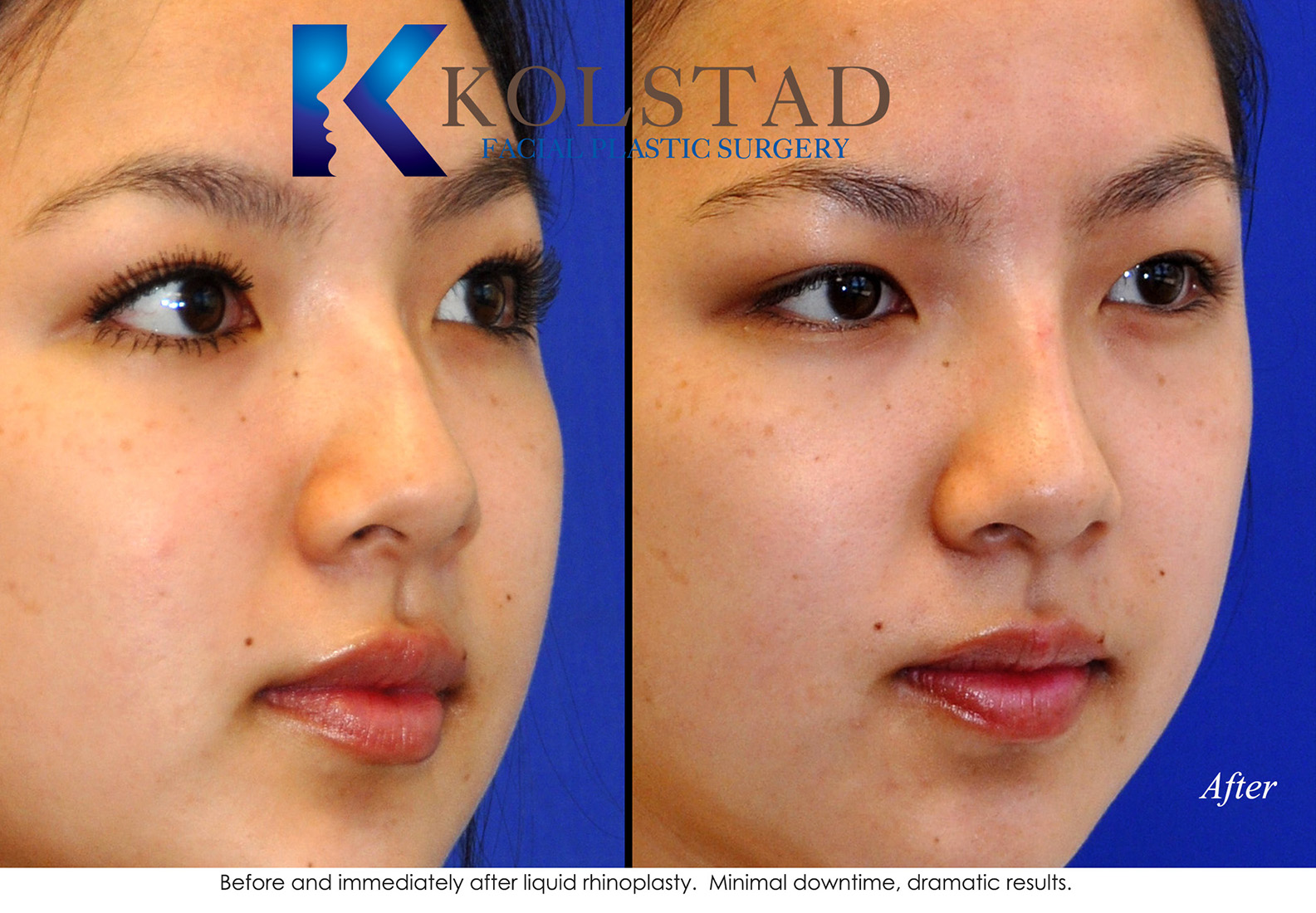 Before and after front view of Asian rhinoplasty showing improved nasal balance and natural-looking refinement while preserving ethnic facial features.