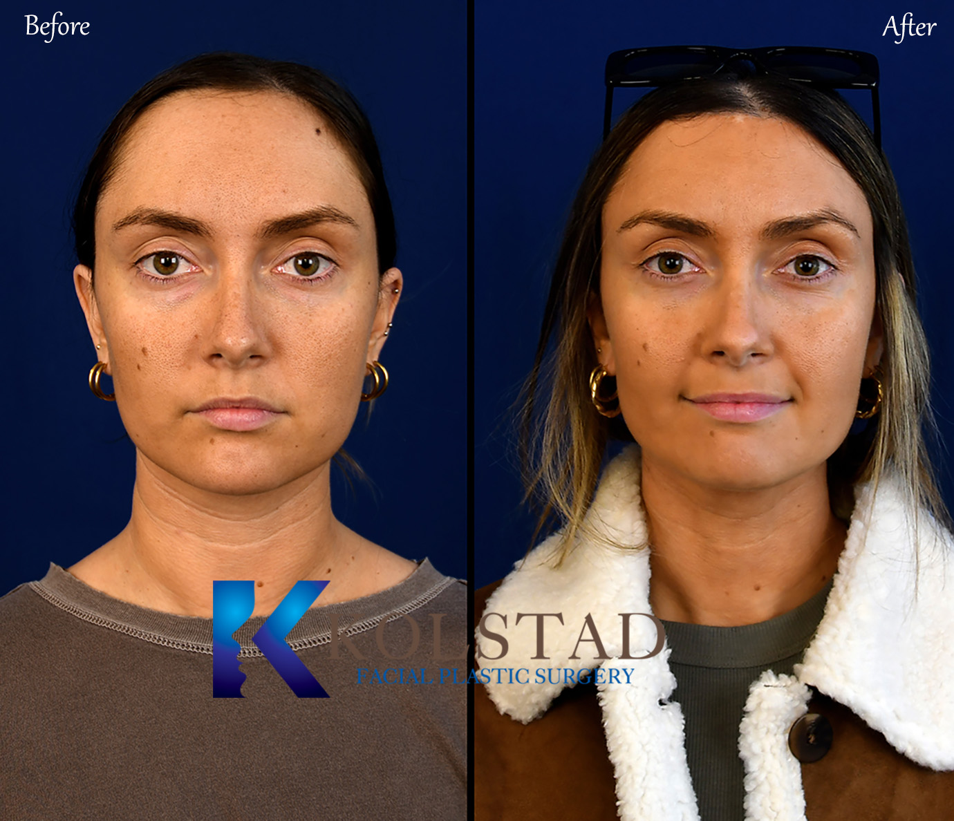 Profile view before and after anterior hairline advancement surgery showing a lower hairline and improved forehead-to-face proportions with natural-looking results.