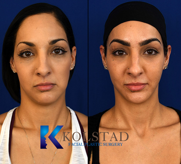 Cheek filler before and after showing improved cheek volume, enhanced midface contours, and a more lifted appearance in La Jolla, California