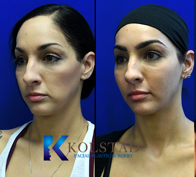 Cheek filler before and after showing enhanced cheek volume, improved facial contours, and a more defined appearance from the front view in San Diego, California