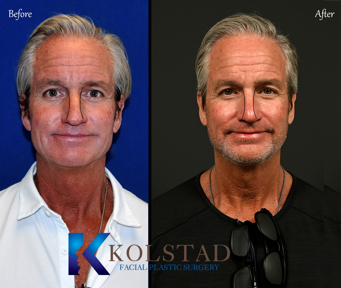 Before and after male rhinoplasty showing refined dorsal aesthetic lines and improved nasal contour while maintaining natural masculine facial balance.