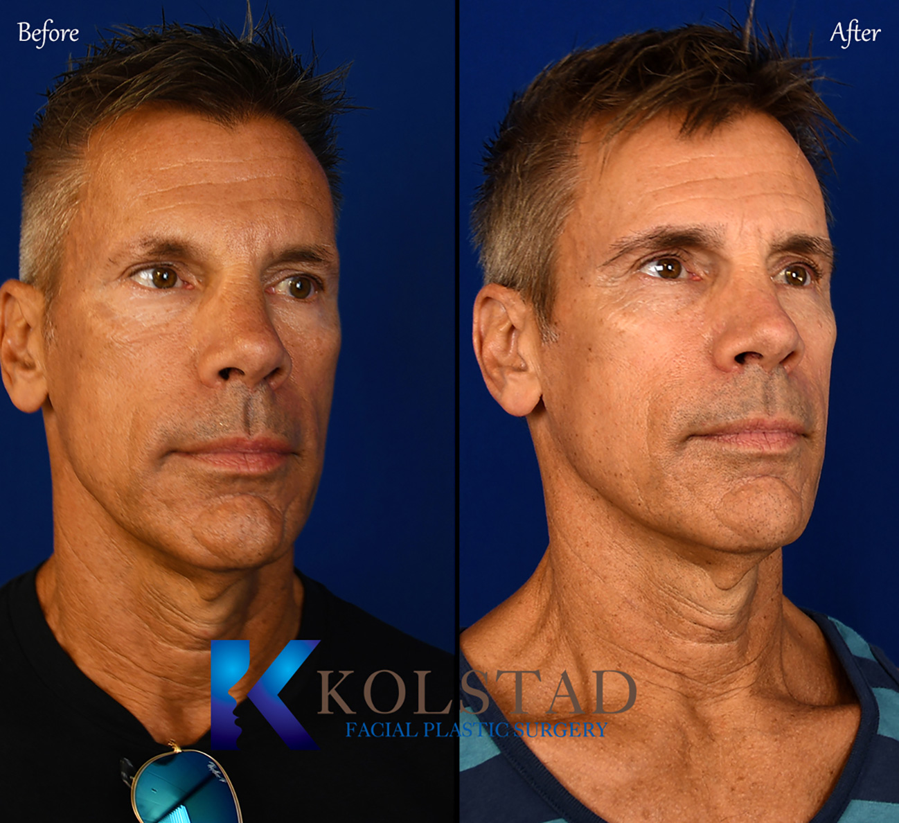 Before and after eyebrow transplant showing natural-looking eyebrow restoration with improved fullness and shape in San Diego