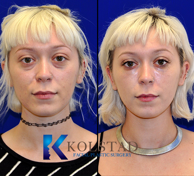 Profile view before and after facial fillers showing enhanced cheek volume, softened facial lines, and improved overall facial harmony in La Jolla.