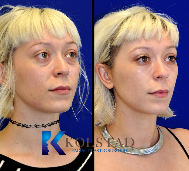 Before and after facial fillers in front view showing restored facial volume, smoother contours, and natural-looking rejuvenation in San Diego, California.