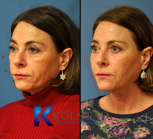Profile view of fat transfer before and after results showing fuller cheeks and improved facial volume with natural-looking enhancement.