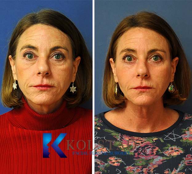 Before and after fat transfer results showing restored facial volume and smoother facial contours.