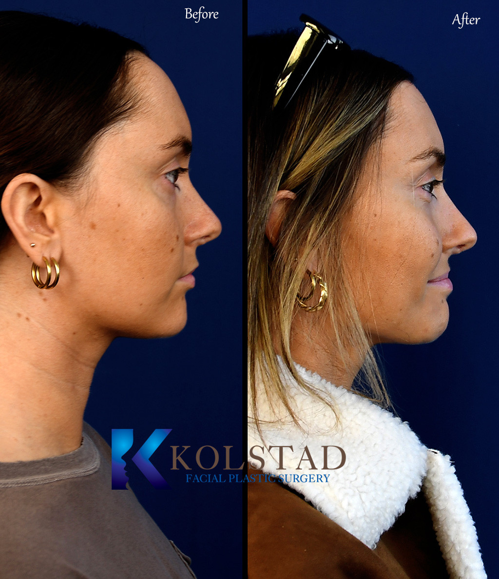 Front view before and after forehead reduction surgery showing a lowered hairline and more balanced forehead proportions with natural-looking results.
