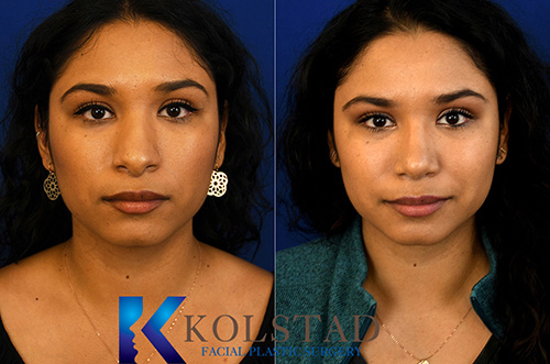 Hispanic rhinoplasty before and after showing refined nasal contours and improved facial harmony from the front view in San Diego, California