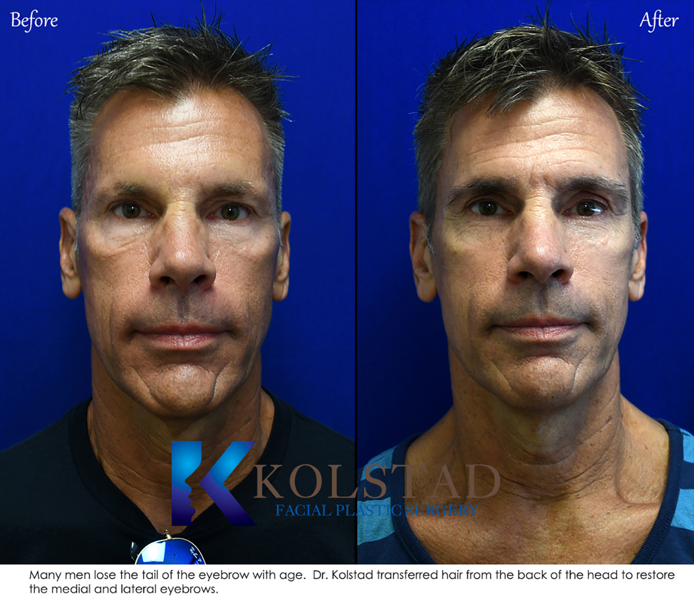 Before and after eyebrow transplant showing natural-looking eyebrow restoration with improved fullness and shape in San Diego