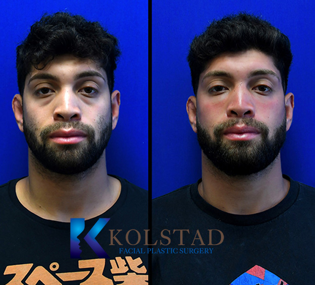 Tear trough before and after showing improved under-eye hollows and a smoother appearance from the front view in La Jolla, California