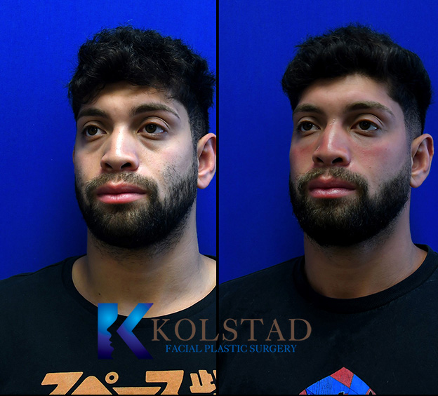 Tear trough before and after showing a smoother, refreshed appearance under the eyes in San Diego, California