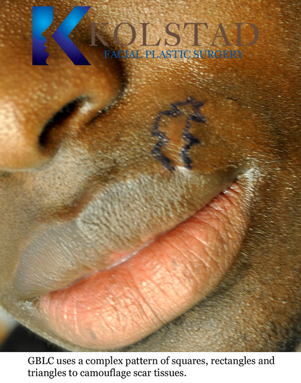 Before and after scar revision showing a smoother, less noticeable scar in San Diego, California.