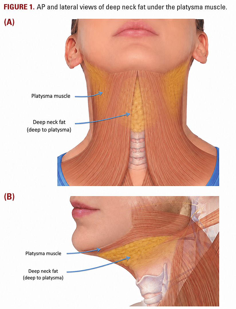 http://deep-neck-fat-removal