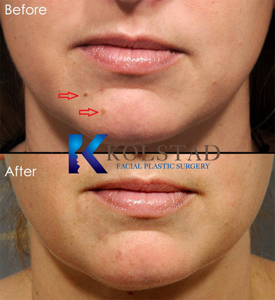 Before and after cosmetic mole removal showing a smoother, more even skin appearance in San Diego, California.