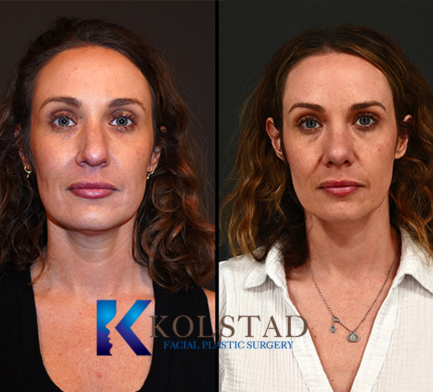 2 ultrasonic rhinoplasty 11