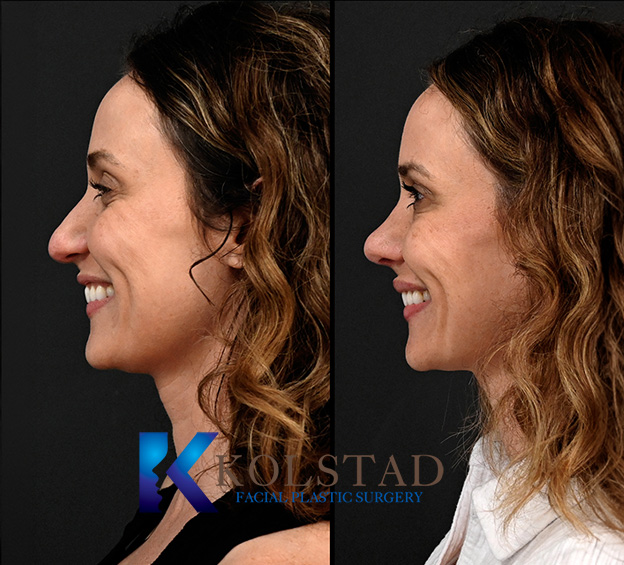 2 ultrasonic rhinoplasty 13